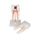 Lower Molar with Caries Model