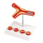 Atherosclerosis and Thrombosis Model